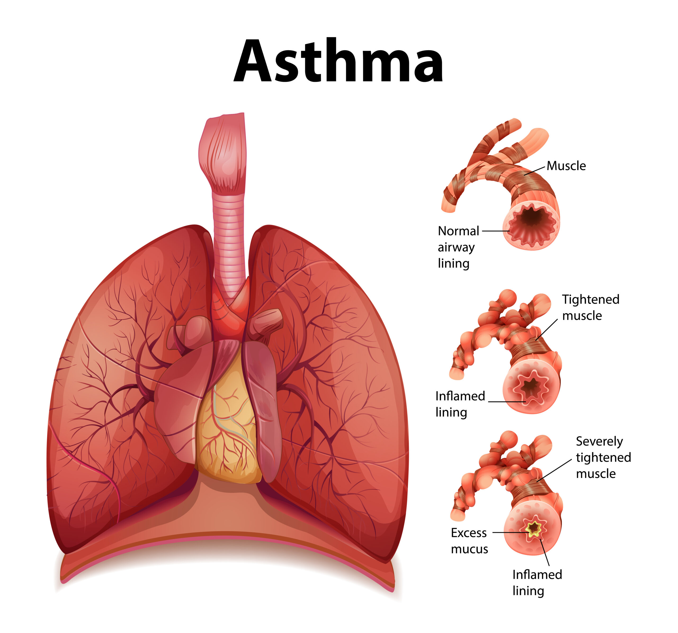 Infographic explaining chronic asthma: a respiratory disease characterized by inflammation and airway narrowing, leading to difficulty breathing, wheezing, coughing, and shortness of breath. It affects people of all ages and can range from minor to severe. Common triggers include exercise, stress, allergies, and respiratory infections. Effective management involves medication, symptom monitoring, and avoiding triggers.